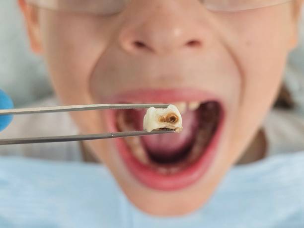 Best Emergency Tooth Extraction in Meridian, MS